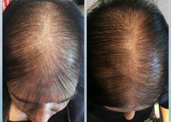 Mittel gegen Haarausfall – Hairdreams Stop & Grow