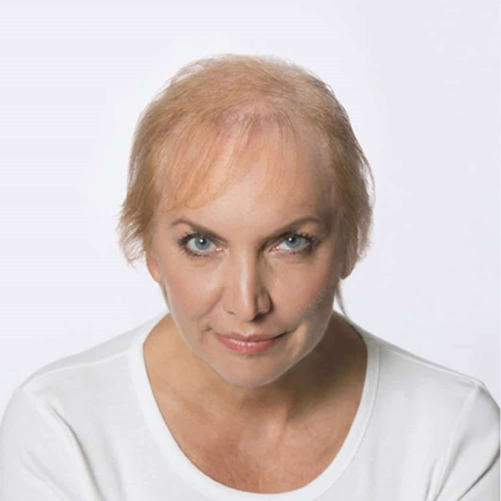 hd-haarverdichtung-oberkopf-microlines-uschi-vorher-komp